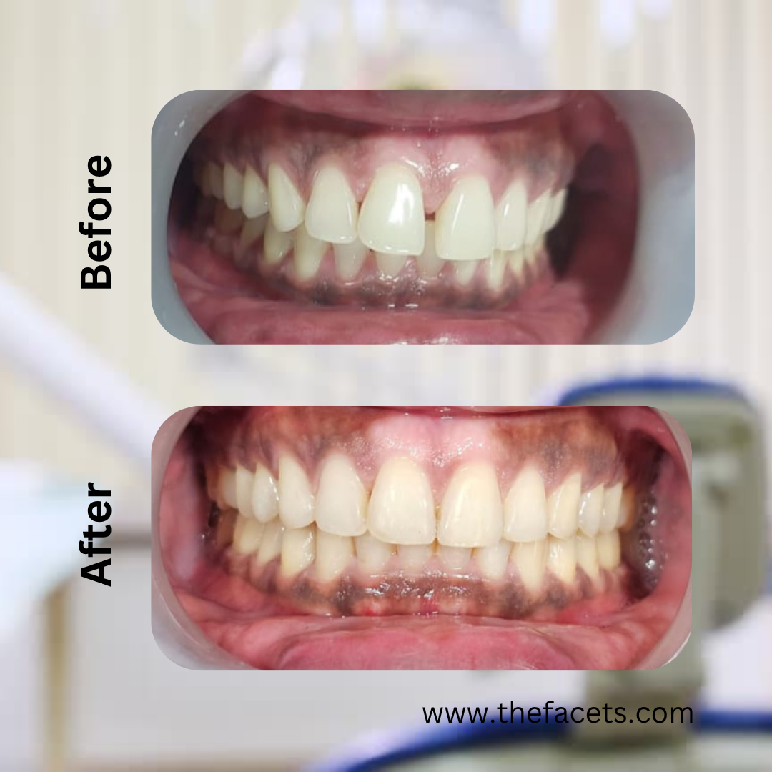 Before and after clear aligner treatment result 5